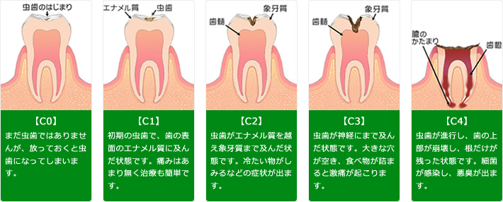 虫歯の進行具合について